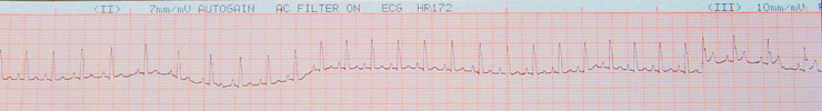 EKG