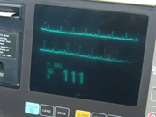 EKG monitor